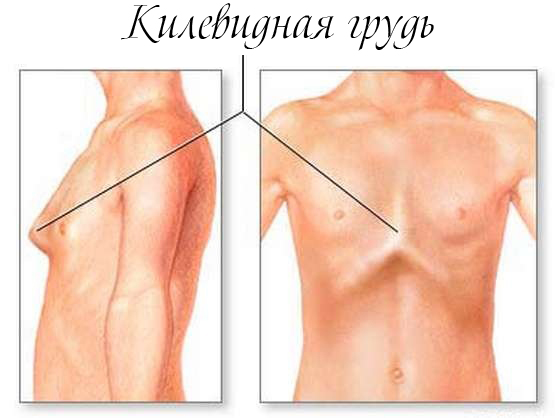 Методы лечения килеобразной груди.