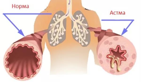 Бронхиальная астма у взрослых симптомы, лечение и профилактика.