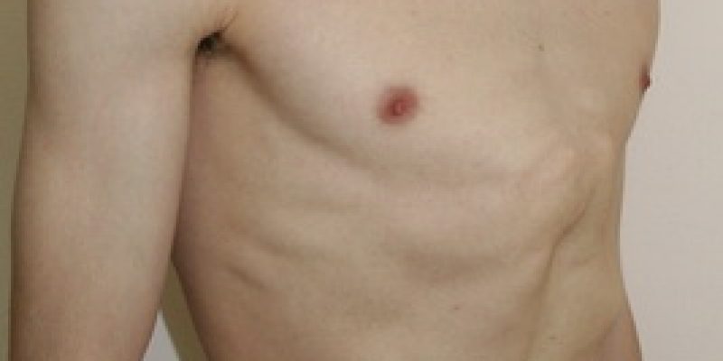 Photo of Упражнения при килеобразной груди
