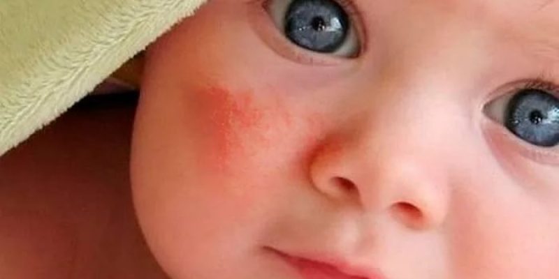 Photo of Аллергия у ребенка, симптомы, диагностика и лечение