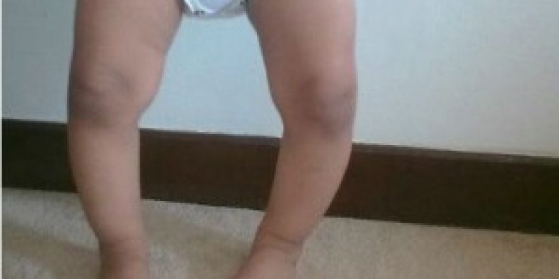 Photo of Оздоровительная физкультура при О-образной деформации ног у детей